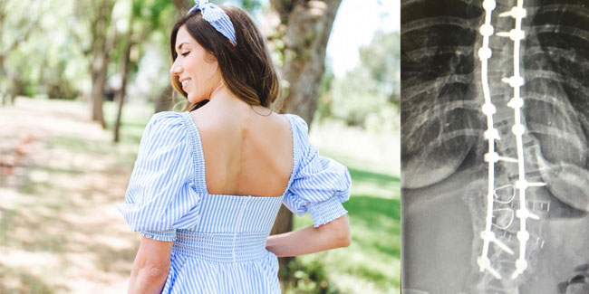 25 June - International Scoliosis Awareness Day 25 June - International Scoliosis Awareness Day