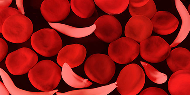 19 June - World Sickle Cell Day