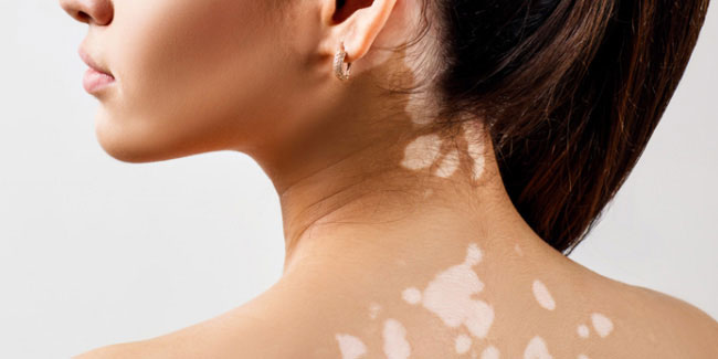 25 June - World Vitiligo Day